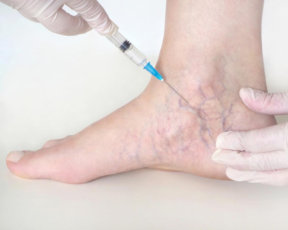 What Are Some Treatments for Varicose Veins?